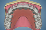 Active Retainer After Replapse